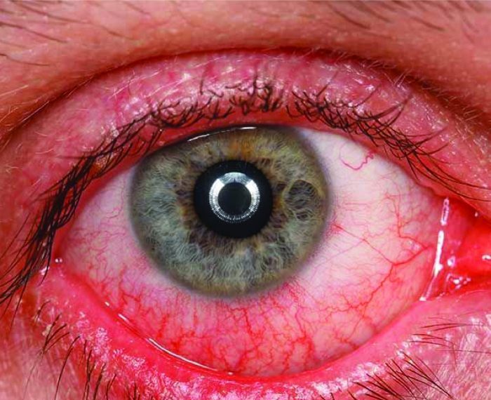 Retinal Disease – Retinal Detachment – THONEH